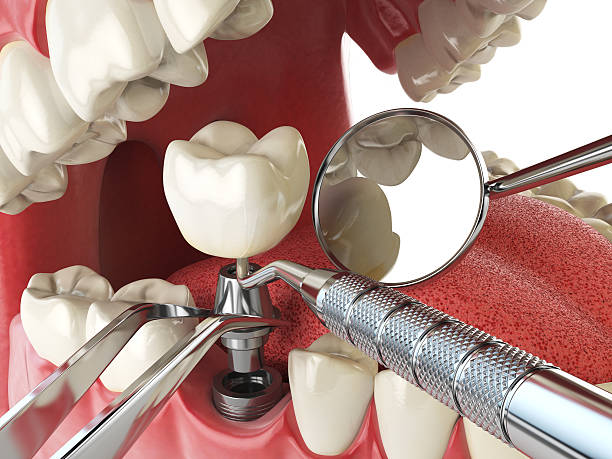 Best Emergency Treatment for Dental Infections or Abscesses in Danville, KY